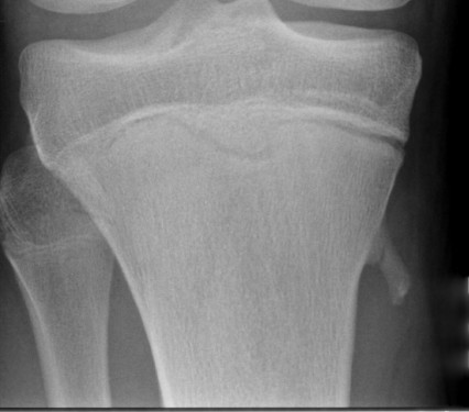 Osteochondroma irritating Pes anserinus